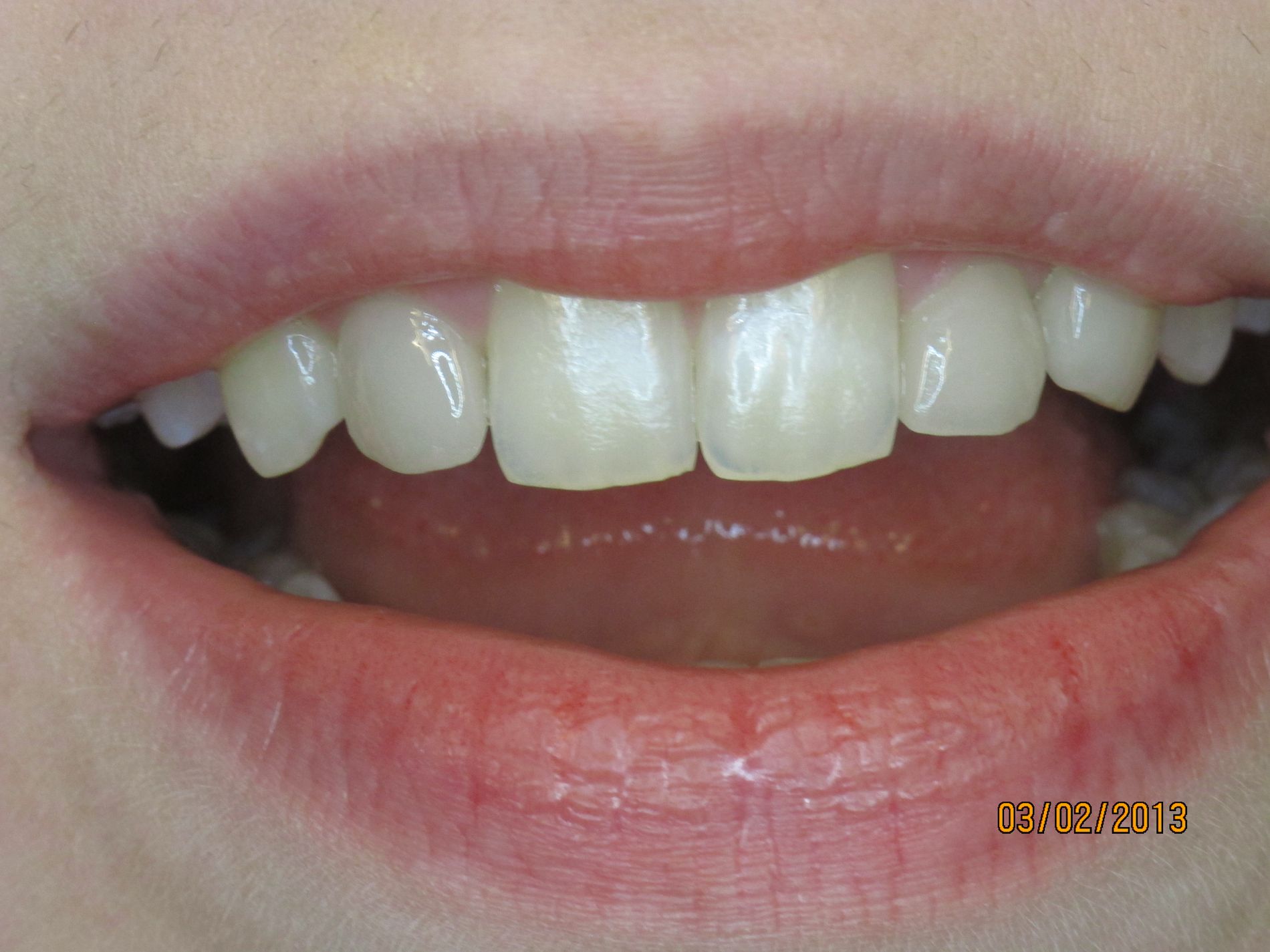 Formkorrektur mit Veneers